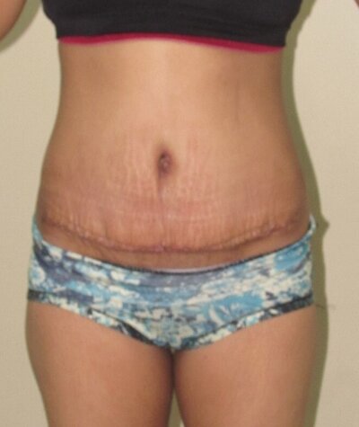 Tummy Tuck Before and After 06
