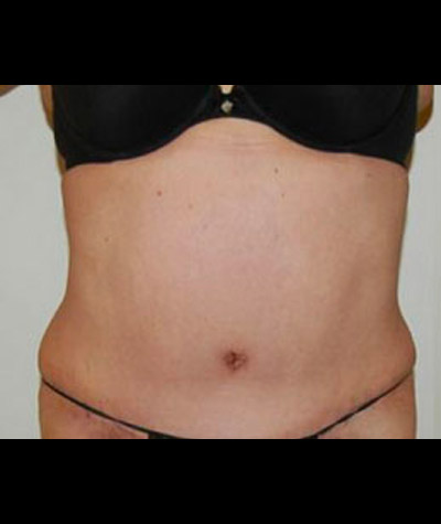 Tummy Tuck Before and After 06