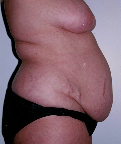 Tummy Tuck Before and After 09
