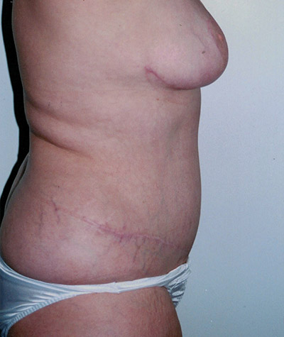 Tummy Tuck Before and After 06