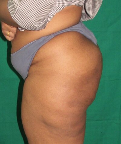 Liposuction of the Buttocks Before and After 01