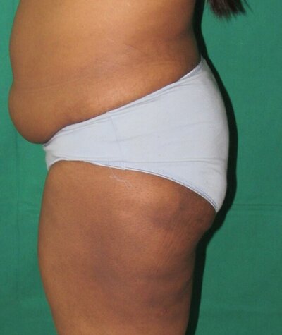 Liposuction of the Buttocks Before and After 01