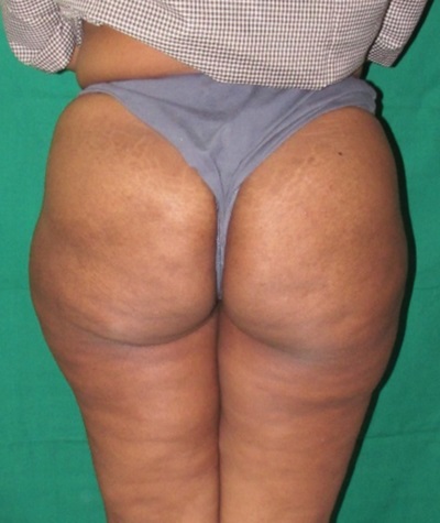 Liposuction of the Buttocks Before and After 02