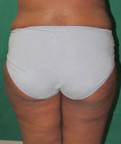 Liposuction of the Buttocks Before and After 02