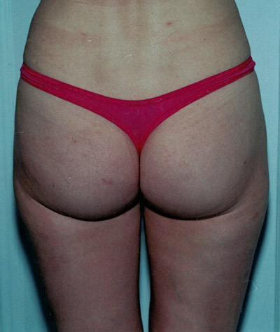 Liposuction of the Buttocks Before and After 02