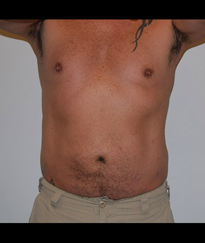 Liposuction Before and After 02