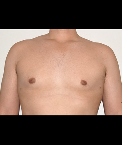 Liposuction Before and After 02