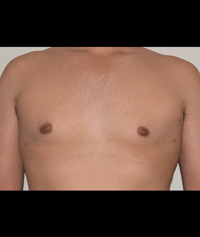 Liposuction Before and After 02