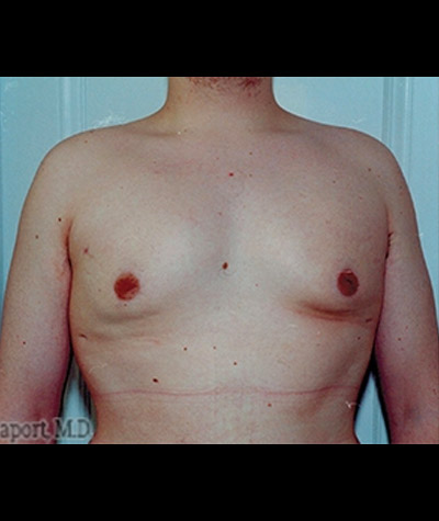 Liposuction Before and After 02