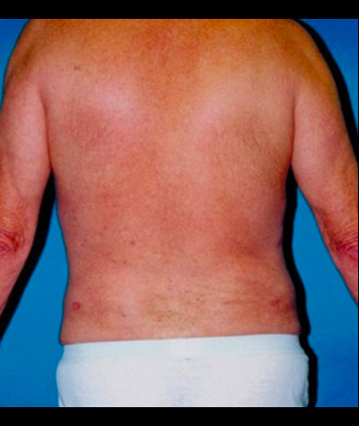 Liposuction Before and After 02