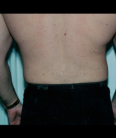 Liposuction Before and After 02