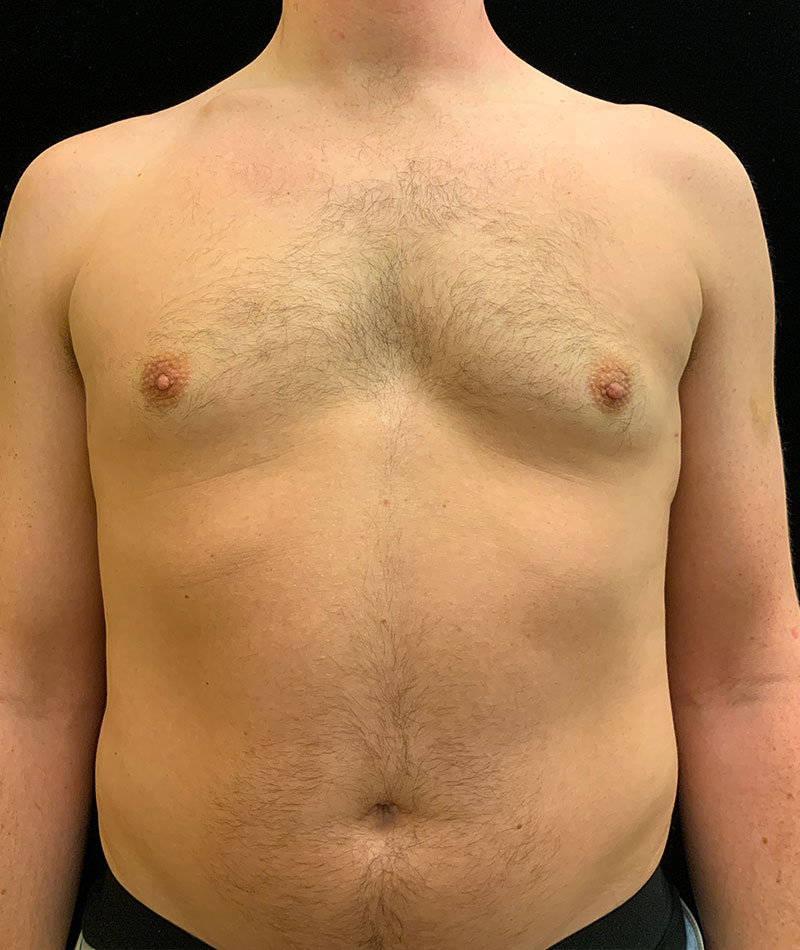 Liposuction Before and After 02